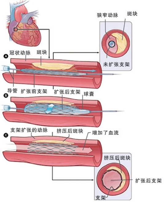 怎樣治療冠心??？(圖2)