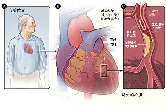 怎樣治療冠心??？(圖3)